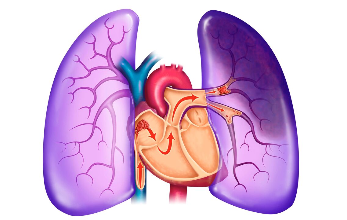 hipertensión pulmonar